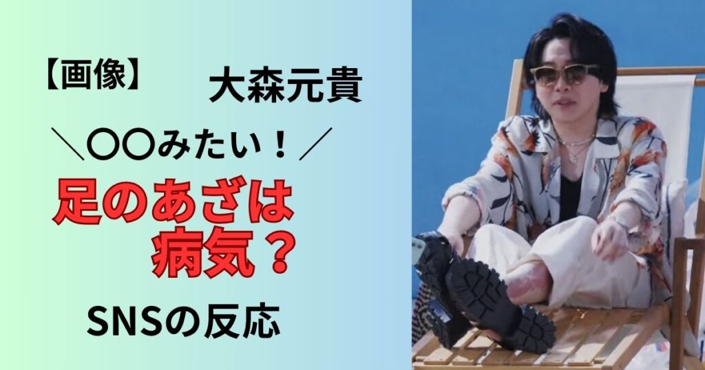 大森元貴の足のあざは病気？生まれつき？原因調査！