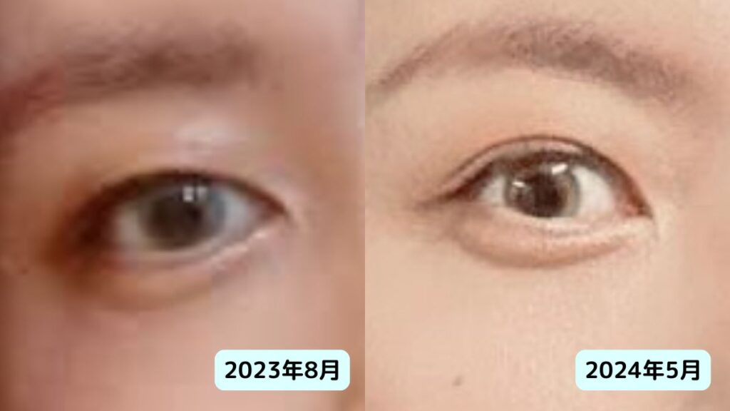 ミセス藤澤涼架は整形？鼻が高い理由と二重幅はいつからか